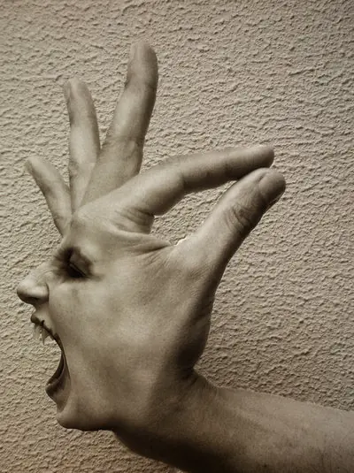 Sindrome de la mano extraterrestre Sindrome de la mano extraterrestre