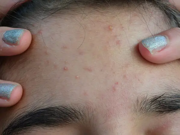 acne