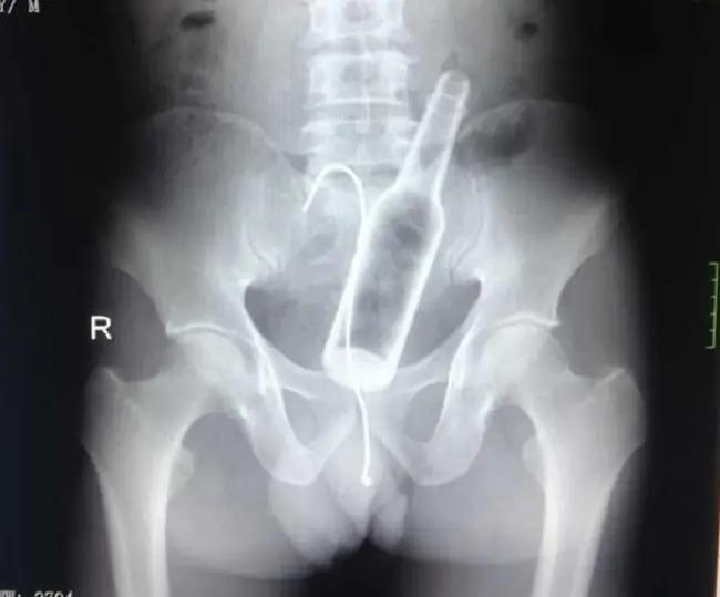 Cosas Increibles Encontradas dentro del Cuerpo Humano