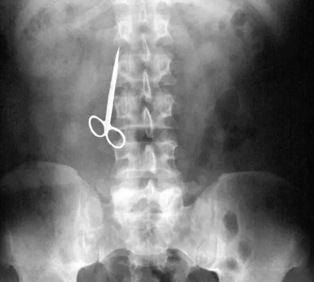 Cosas Increibles Encontradas dentro del Cuerpo Humano