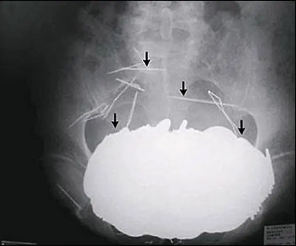 Cosas Increibles Encontradas dentro del Cuerpo Humano