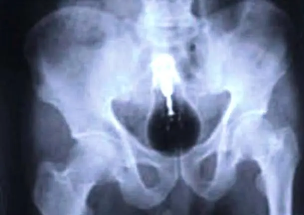 Cosas Increibles Encontradas dentro del Cuerpo Humano