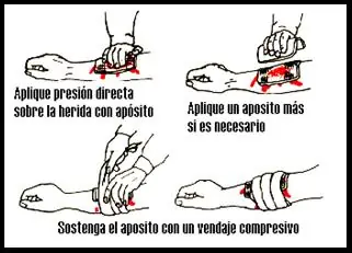 Formas de parar una hemorragia mas segura (Entra y aprende)