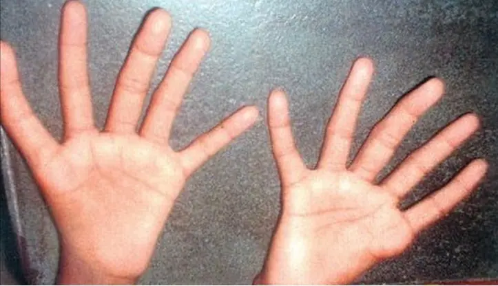 Sindrome de Aase