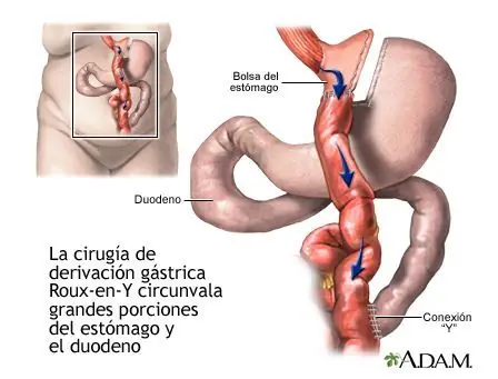 Me hice un By Pass Gástrico y lo cuento