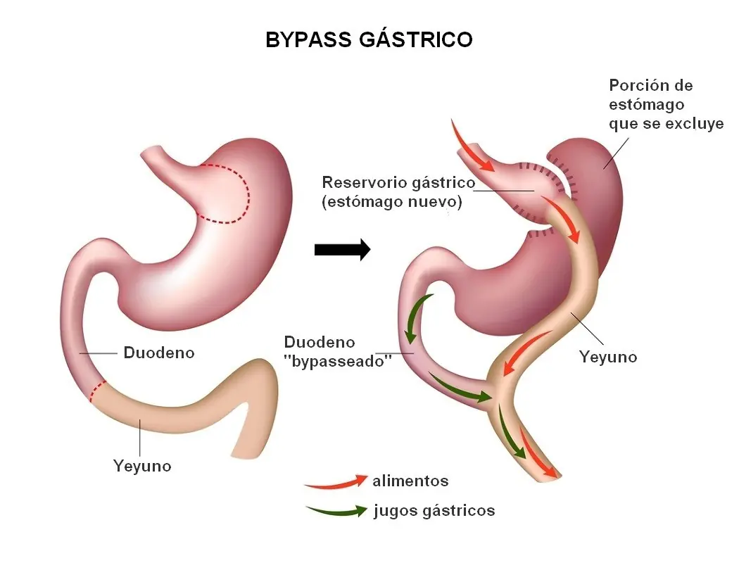 bypass gastrico