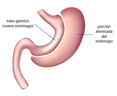 obesidad
