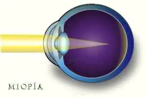 Infecciones y Enfermedades de Ojos