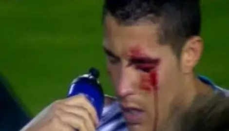 Cristiano Ronaldo sufre grave lesión VER