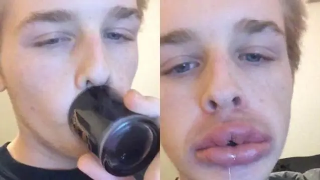 La tenebrosa moda de "tener los labios de Kylie Jenner"