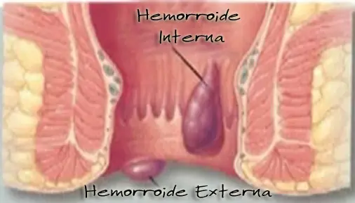 hemorroides