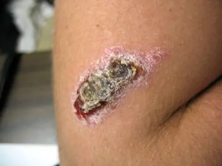 Como prevenir la Leishmaniasis .