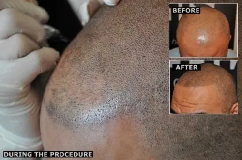 Se tatuó pelo en la pelada