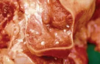 Cisticercosis (gusanos en la carne de cerdo y humanos)