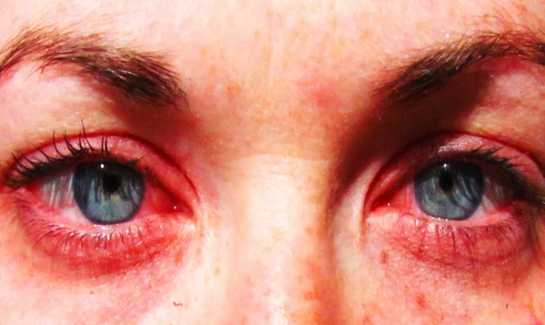 5 alergias súper extrañas