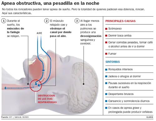 Apnea obstructiva del sueño
