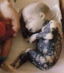 abortos