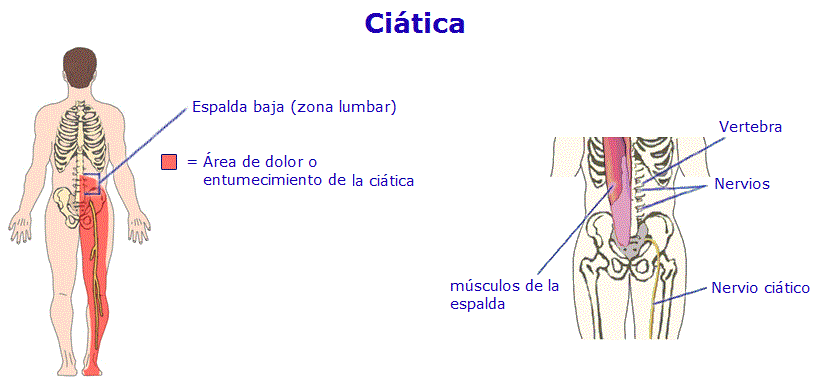 Ciática, ¿qué es?. Entra que te cuento