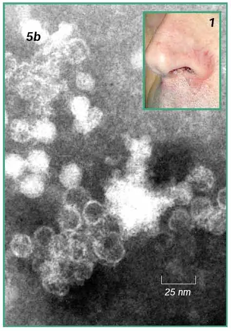 faringitis estreptococica