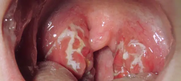 faringitis viral