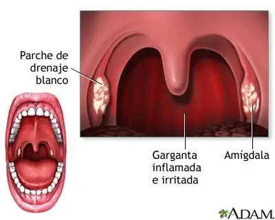 faringitis