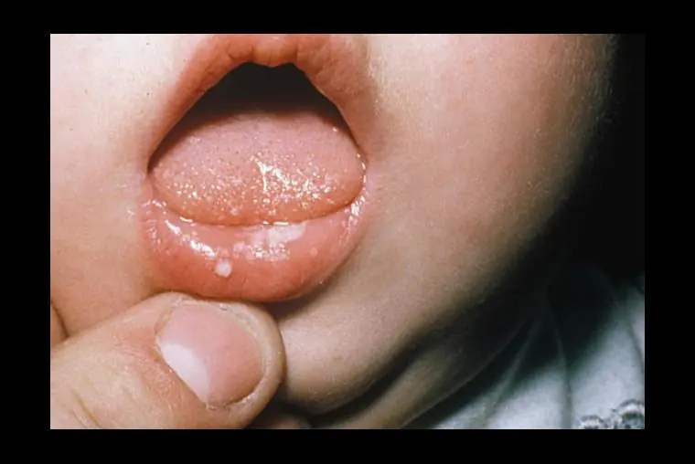 ¡Atención! 10 enfermedades que puedes adquirir con un BESO