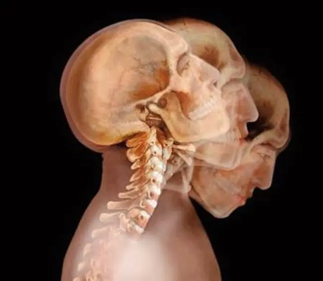 El primer trasplante de cabeza humana.
