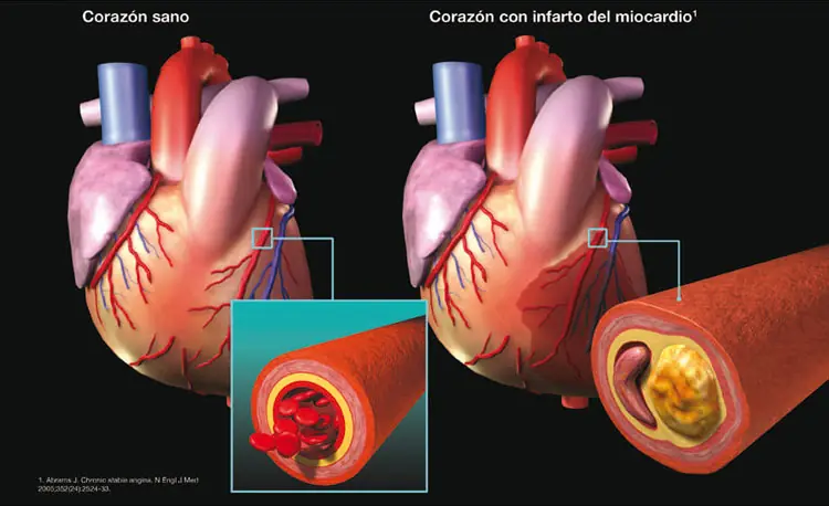 ataque al corazon