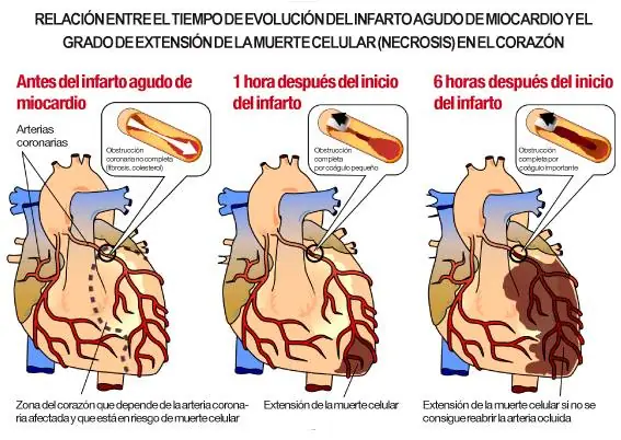 infarto agudo al miocardio