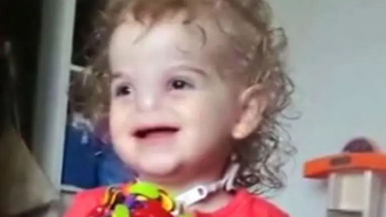 La conmovedora historia de una niña sin nariz