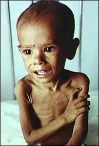 Desnutricion y pobreza en el Mundo