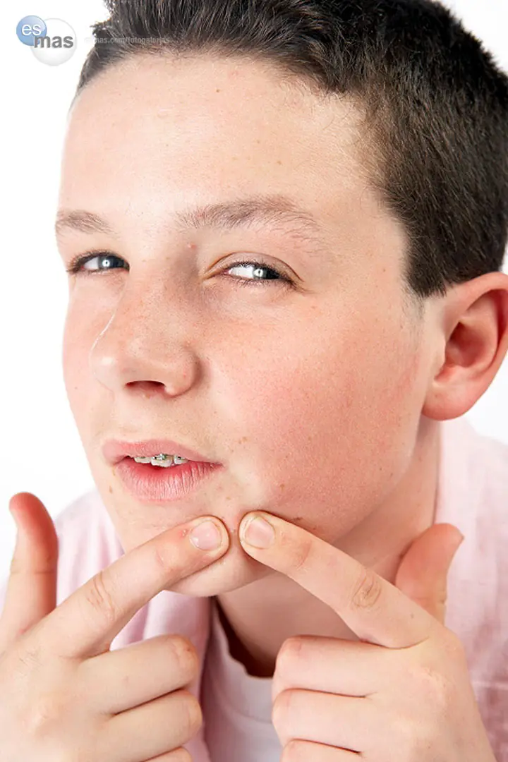 Todo sobre Acne, granos y espinillas