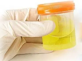 Análisis de orina: Cómo interpretar los resultados