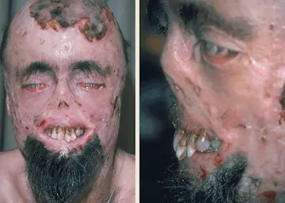 Las 10 enfermedades mas extrañas del mundo