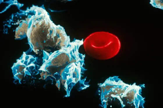 leucemia leucemia