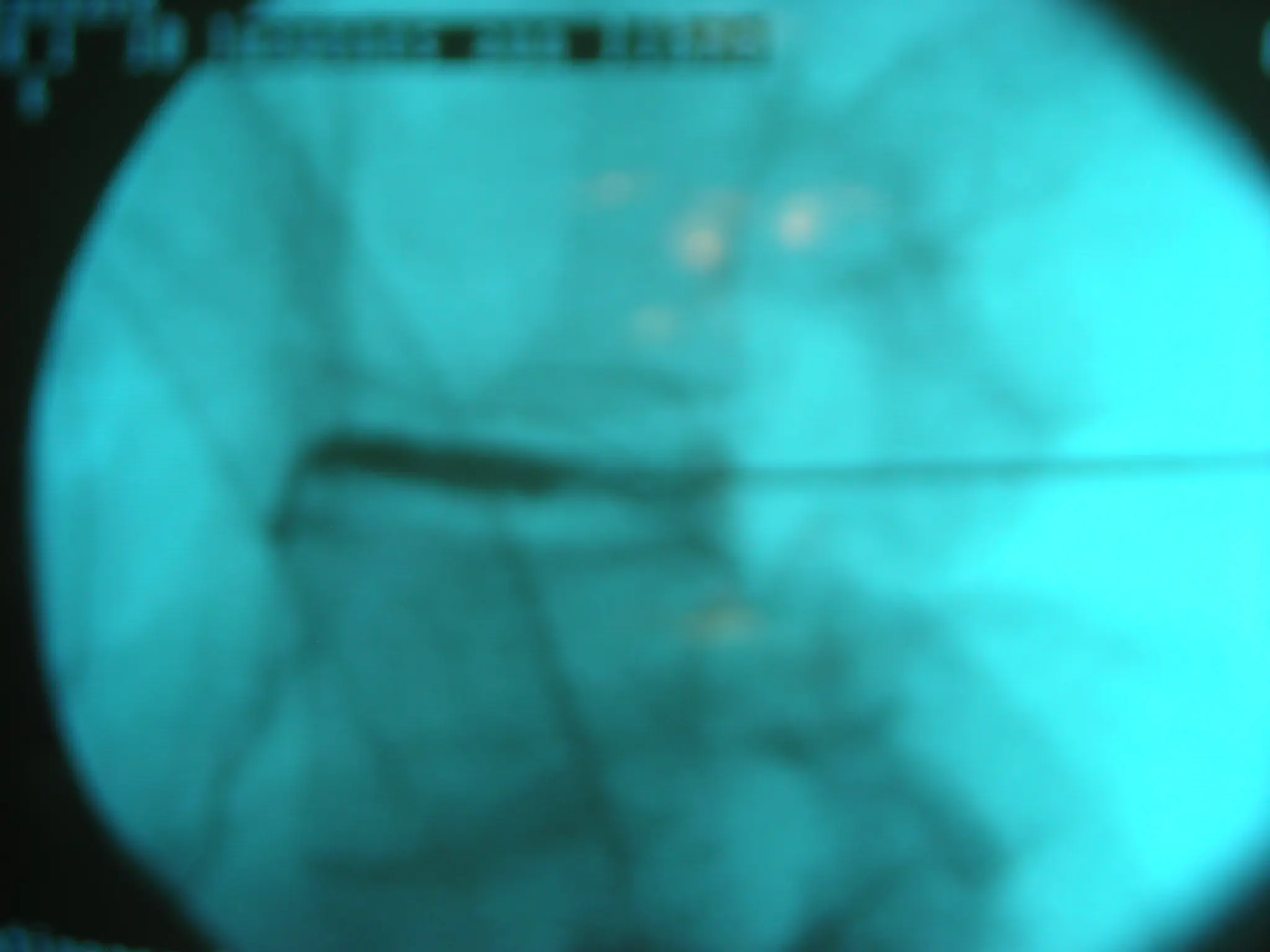 hernia discal