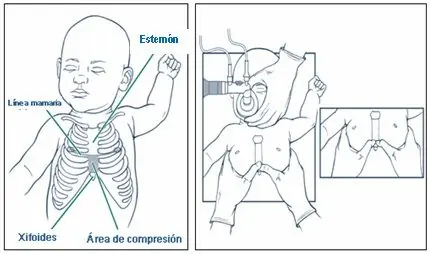 reanimacion