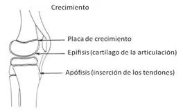 acondoplastia acondoplastia