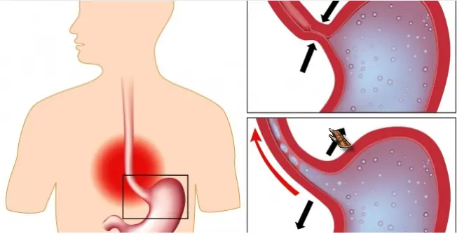 7 remedios para acabar con el reflujo y la acidez estomacal
