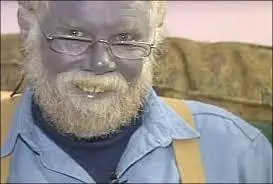 Top las 18 anomalias medicas mas extrañas del mundo :)