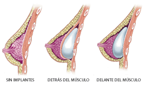 Diferencias entre senos naturales y de silicona