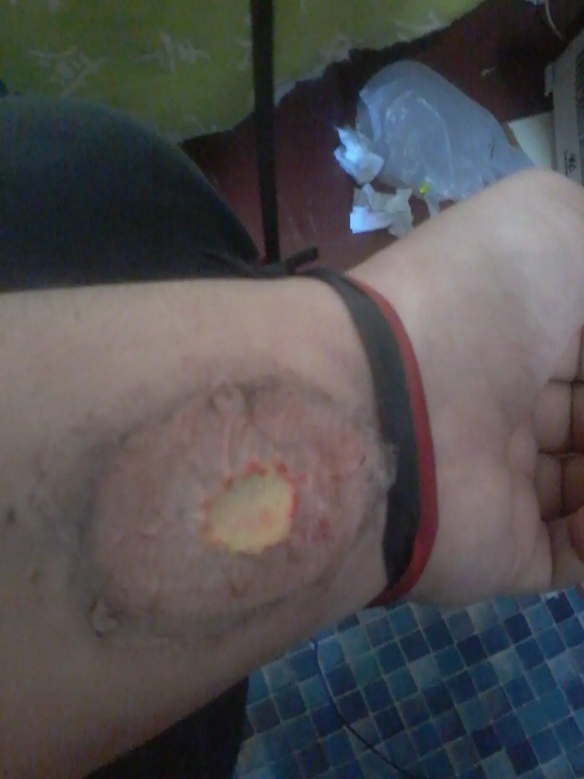 heridas