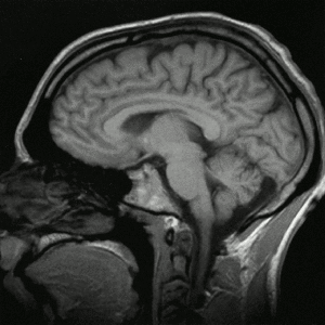 extracorporal