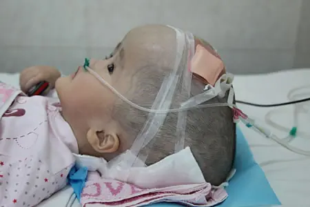 Trasplantan cráneo impreso en 3D a una niña con hidrocefalia Trasplantan cráneo impreso en 3D a una niña con hidrocefalia