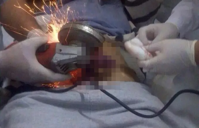 Se masturbó con un caño y acabó con el pene atascado