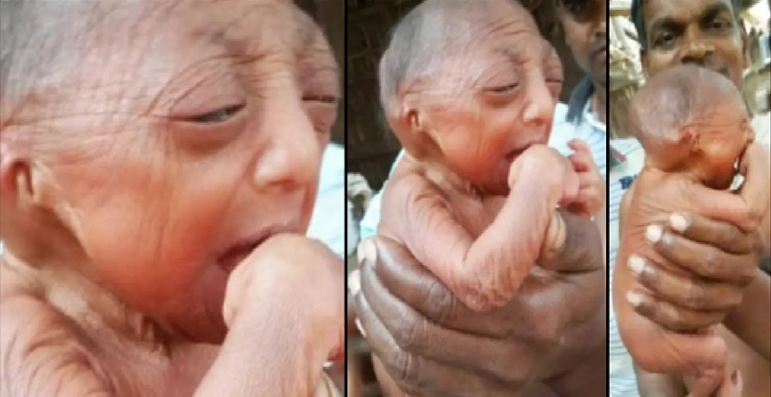 Nace el Benjamin Button real.