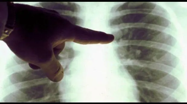 Crean tecnología 3D para diagnosticar enfermedades pulmonare