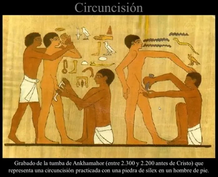 Razones de la circuncision,riesgos y beneficios