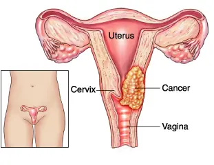 cancer de cuello uterino