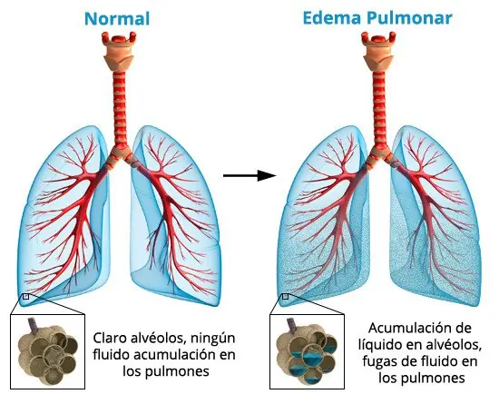 venenos de aranas